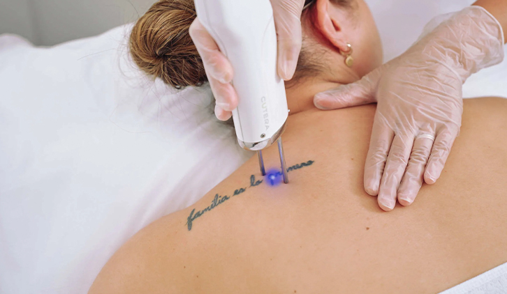 Best Laser Tattoo Removal In Parigi, Vikarabad | Laser Tattoo Removal Treatment in  Vikarabad